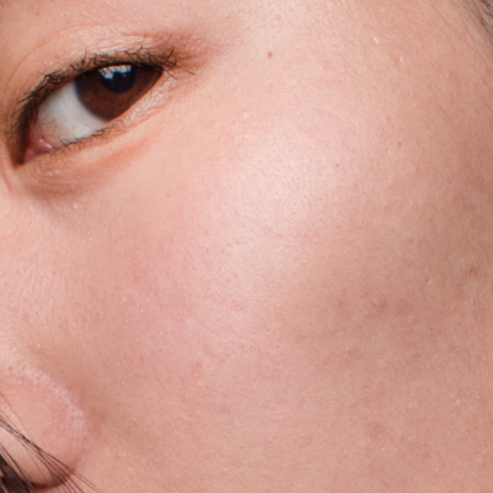 Post-Inflammatory Hyperpigmentation