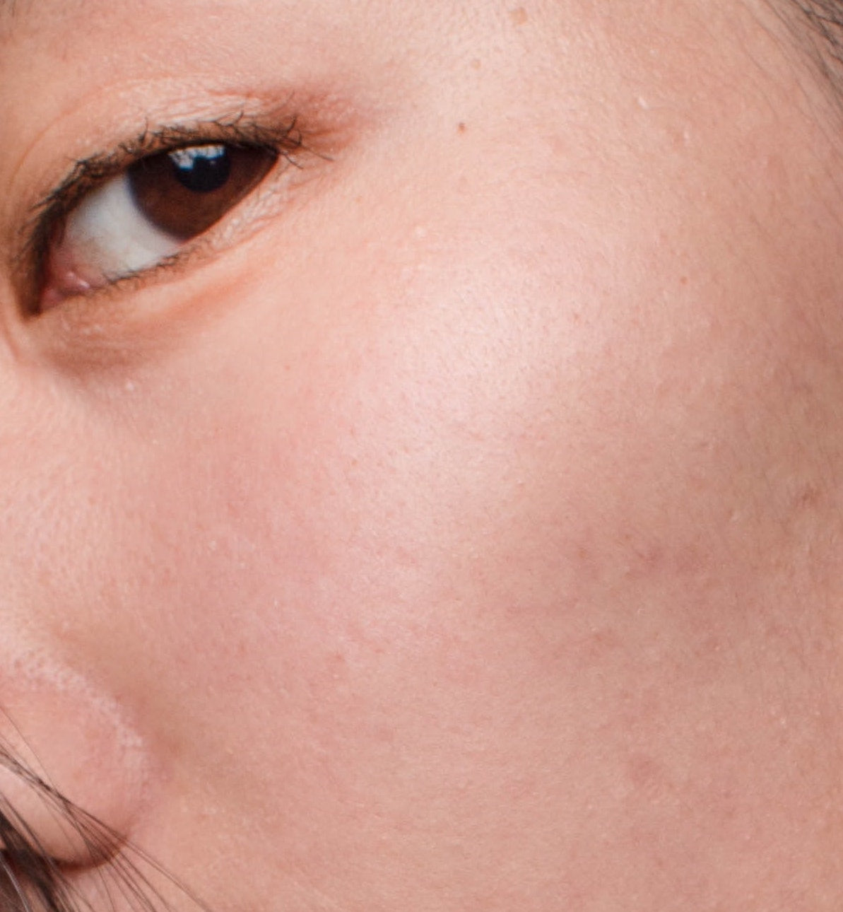 Post-Inflammatory Hyperpigmentation