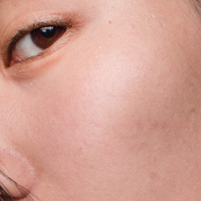 Post-Inflammatory Hyperpigmentation